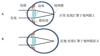 矫正视力是什么意思？矫正视力能达到多少？