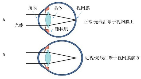 矫正视力是什么意思？矫正视力能达到多少？